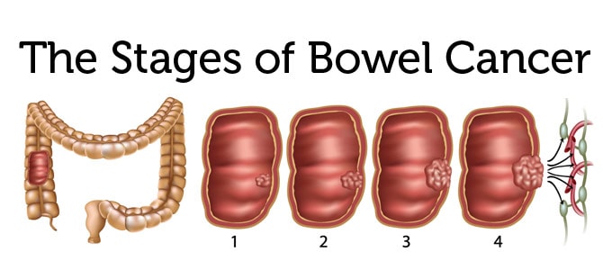 Stages Of Cancer