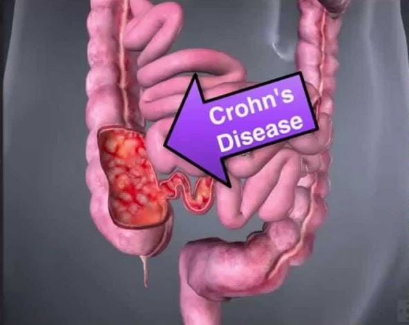 Crohns Disease Causes