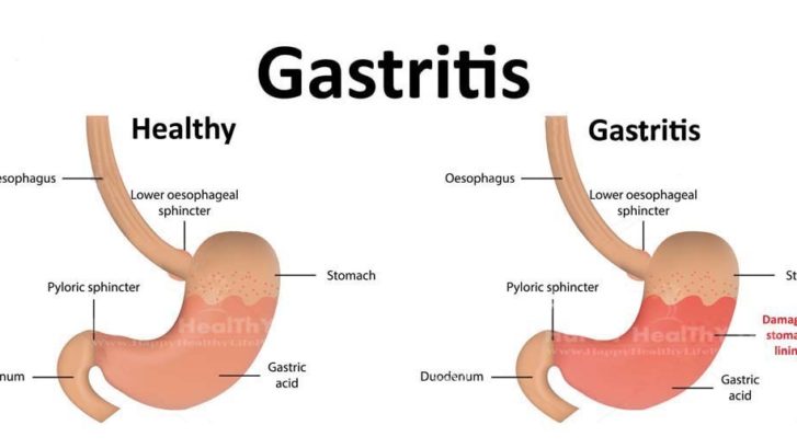 gastritis