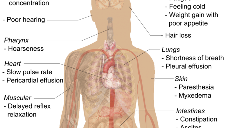 Hypothyroidism