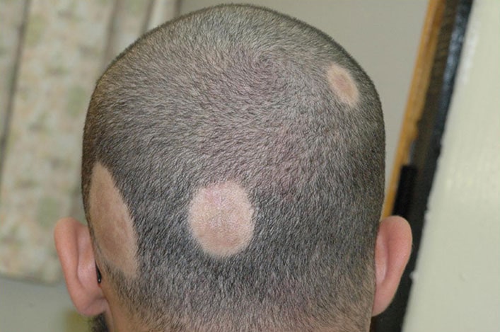 Alopecia Areata Homeopathy Treatment Lucknow, Delhi & Mumbai, India -  Expert Cancer Homoeo Clinic