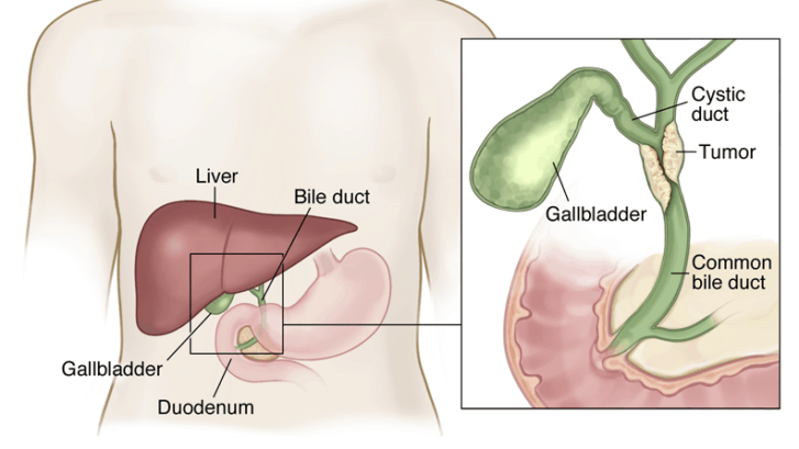 Bile Duct Cancer Treatment Clinic