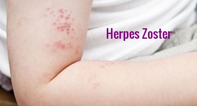 mild herpes zoster