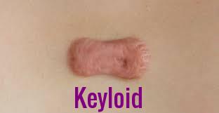 Keyloid