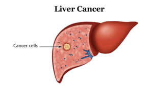 Liver Cancer Homeopathy Treatment In Mumbai, Delhi & Lucknow - Expert ...