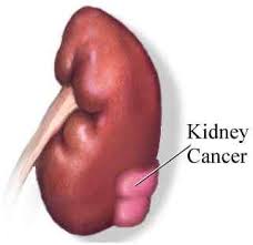 Kidnycancer