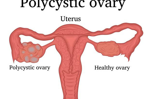 Can PCOD Cause Unexplainable Weight Gain