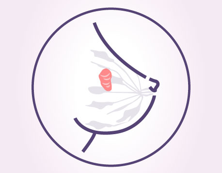 Fibroadenoma of Breast