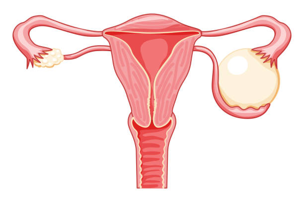Ovarian cysts