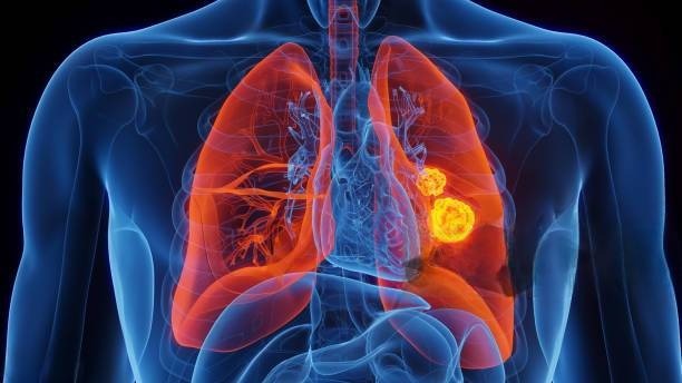 lung cancer - Types, Diagnosis and treatments