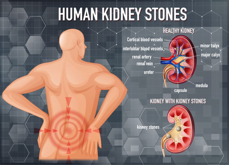 How to Stop Kidney Stone Pain at Home
